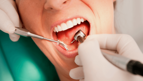 Periodontal Regeneration