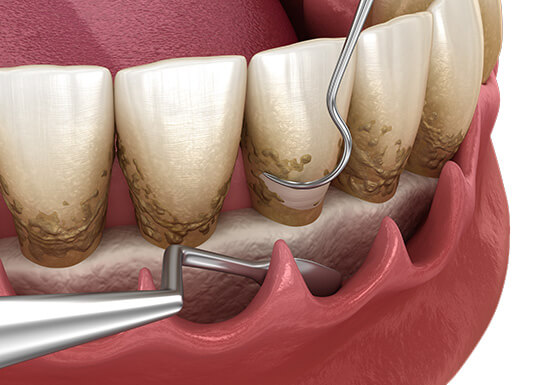 Periodontitis_Access-Surgery