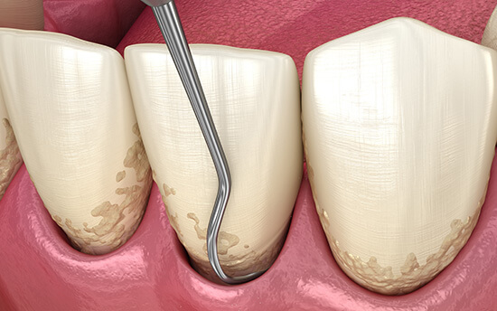 Periodontitis_Prof-dental-clean