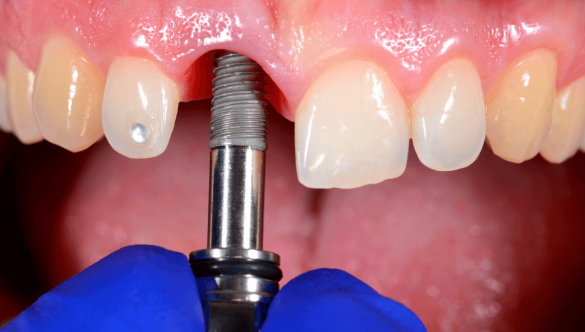 Classification of periodontal health and conditions