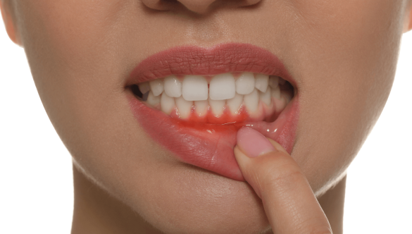 Bone and Gum Grafting