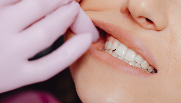Periodontal Maintenance Therapy