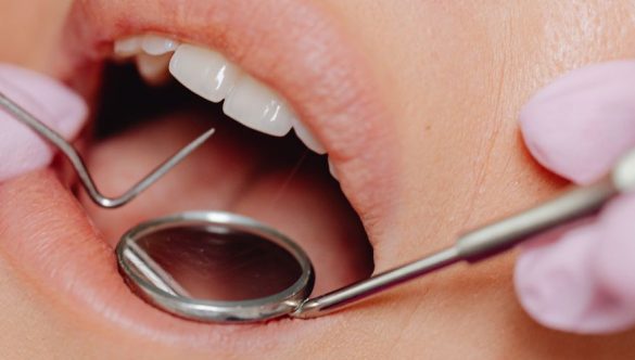 Guided Dental Implants