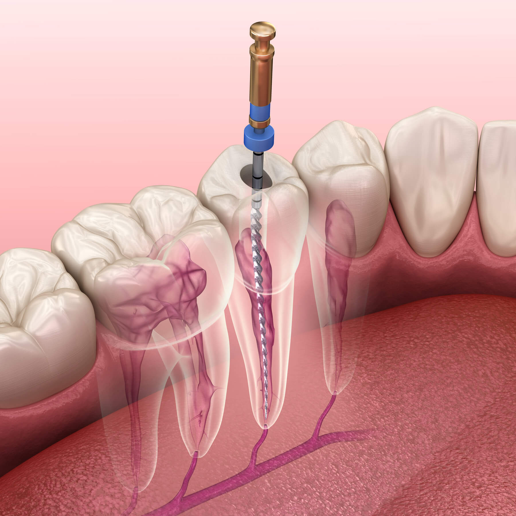 Root Canal Therapy